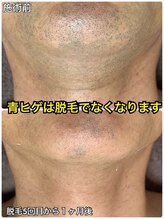 シャイン(shine)/ヒゲ脱毛