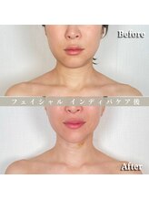 術後の女神 大阪心斎橋店/術後ケアインディバ・インディバ