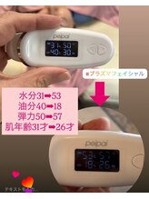 顔凛(カオリン)/肌質改善プラズマフェイシャル