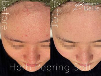 ベル 堀江(Belle)/ハーブピーリング｜ニキビケア