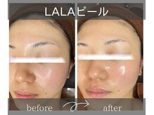 サロンドボーテアリス (Salon de beaute ALICE)/肌の刺激がないララピール◎