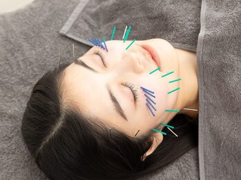 美容鍼灸整体サロンopt./美容鍼でしわ・たるみの改善
