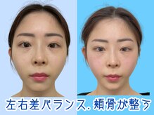 ナチュラルビューティーフェイス 横浜(NBF)/２回目・頬骨改善/横浜駅小顔