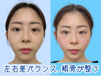 ナチュラルビューティーフェイス 横浜(NBF)/２回目・頬骨改善/横浜駅小顔