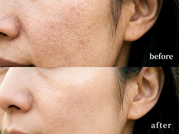 ソレイユ(Soleil)/毛穴・角質ケア