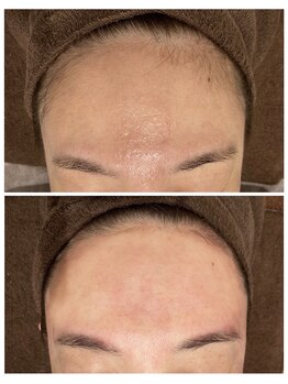 メローワックス 松本駅前店(MELLOW WAX)/フェイスＷＡＸビフォーアフター