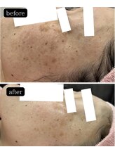 ブレス イオン酒田南店(BLESS)/シミだけでなく肌まで若々しく