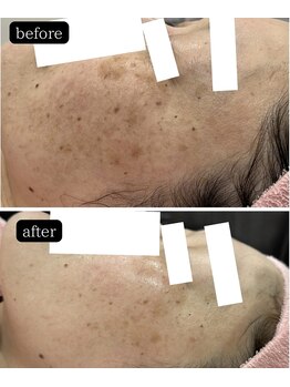 ブレス イオン酒田南店(BLESS)/シミだけでなく肌まで若々しく