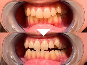 ビースト 下北沢店(B-st.)/セルフホワイトニング｜20分照射