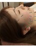 【美容鍼　スタンダード】　45分　8,000円　　インスタで話題の施術　