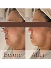 凪眠/小顔リンパフェイシャルの効果45