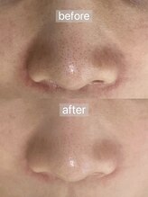 フェリノ(FERINO)/毛穴洗浄×AHA（乳酸）