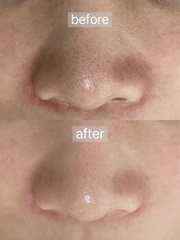 フェリノ(FERINO)/毛穴洗浄×AHA(乳酸)