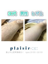 プレジール 富山店(plaisir)/全身脱毛(ヒザ上4回目)