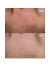 ミリ(MiLi)/スキンメイド