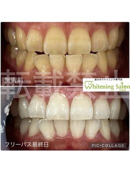ホワイトニングサロン 広島店/【ホワイトニング施術例】