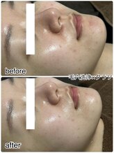 ハーブピーリング/よもぎ蒸し/毛穴/ブライダル/小顔/ララピール