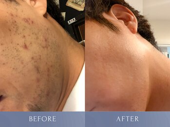 カズキ ハギワラ(Kazuki Hagiwara)の写真/メンズ脱毛は安心・低痛みが重要！高出力で効果◎悩みのない肌と快適な生活をあなたに♪