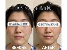 ぶんのいち整体院/美容鍼でリフトアップ