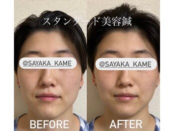 ぶんのいち整体院/美容鍼でリフトアップ