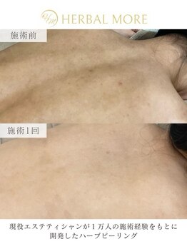 ハーブのほし/お背中/剥けるハーブピーリング