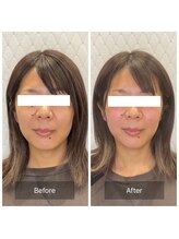 カドル 福岡天神店(KADORU)/小顔矯正+美容機器 Before-Aftet