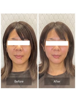 カドル 福岡天神店(KADORU)/小顔矯正+美容機器 Before-Aftet