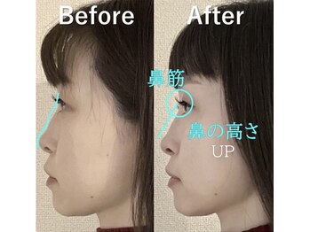 ラプリアンジュ 鹿児島天文館店(Raplit ange)/隆鼻+輪郭矯正40分10回