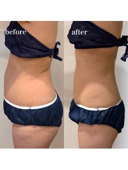 ラヴィス(ravis)/食事、運動制限なし-5kg!