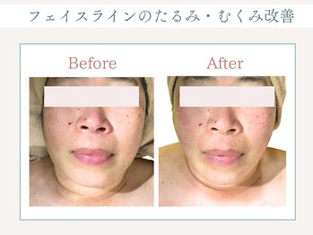 トータルビューティー ゆみえエステ(Total Beauty)/ハイパーナイフ フェイシャル