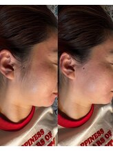 キエズ(KIES)/もみあげワックス脱毛