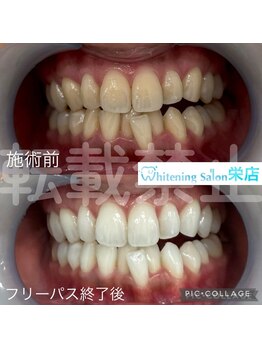 ホワイトニングサロン 名古屋 栄店/【ホワイトニング】