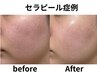 韓国肌管理★セラピール 〈毛穴の開き/凸凹肌〉¥11,000