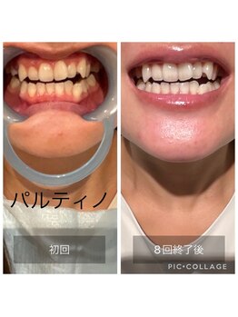 パルティノ 高崎店/【症例】セルフホワイトニング☆