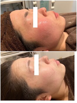 エステサロン ブレス 山形店(BLESS)/フェイシャル結果