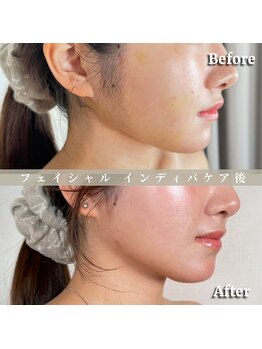 術後の女神 大阪心斎橋店/術後ケアインディバ・インディバ