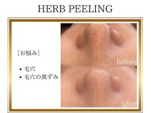 ロージー(ROSY)/ハーブピーリング/阿南/徳島
