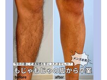 浜松富塚ベルミーランド/脱毛Before→After