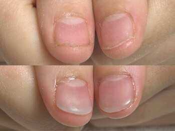 ココモ(cocomo)/深爪/自爪育成/フィルイン