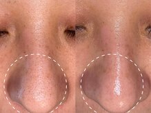 毛穴の改善・ニキビケアが得意です