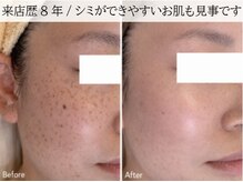 ラグランシエル(Le grand ciel)/長年の肌悩み