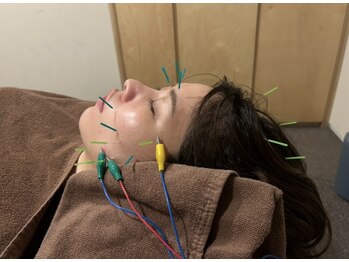 サルース(Salus)の写真/人気No.1【圧倒的効果◎】美容鍼+小顔矯正+ヘッドマッサージ¥9900で美肌×小顔を叶える*期間限定クーポン◎