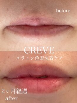 クレーヴ(CREVE)/モニター様経過写真【2ヶ月】