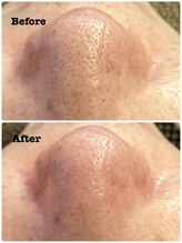 ハリキュア(Hari-Cure)/毛穴の汚れをゴッソリ除去