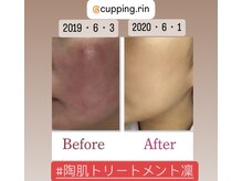 カッピングアンドカッサ専門店 凜(Rin)/陶肌トリートメント4回ビフォー