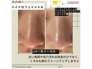 ルアナ(Luana)/ハイドラピーリングコース