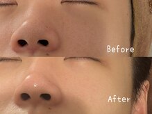 サロン ド モミカル(salon de momikaru)/毛穴洗浄