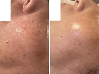 エイチケービューティーサロン(H/K beauty salon)/＼トーンアップ／