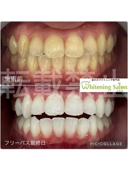 ホワイトニングサロン 広島店/【ホワイトニング施術例】
