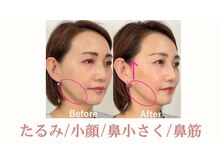 ラプリ 盛岡店(Raplit)の雰囲気（加齢によって広がった鼻を小さく/ 盛岡/小顔/小顔矯正）